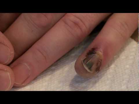 how to drain infected finger