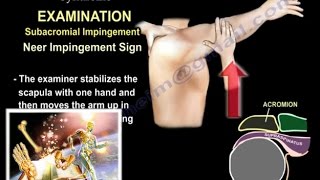 Shoulder Impingement Syndrome - Everything You Need To Know - Dr. Nabil Ebraheim