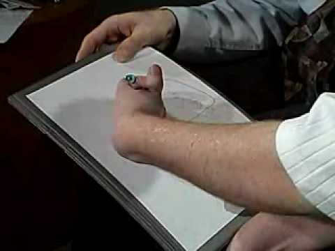 dysplasia in left occipitalleft parietal lobes dysplasia in left occipitalleft parietal lobes