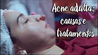 Acne adulta: causas e tratamentos