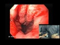 Endoscopy of Barrett Adenocarcinoma