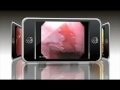Endoscopy of Barrett Adenocarcinoma
