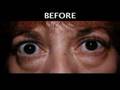 Treatment of Thyroid Eyelid and Orbit Disorders