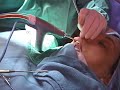 Endoscopic Caldwell-Luc Procedure Endoscopic Caldwell-Luc Procedure
