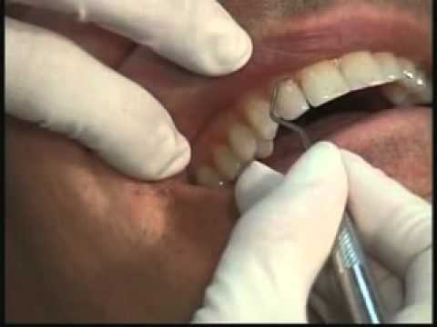 how to cure gum abscess