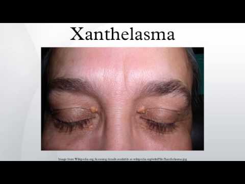 how to remove xanthelasma