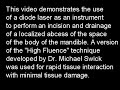 Diode Laser Incision and Drainage Diode Laser Incision and Drainage