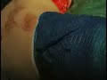 Avance de la tuberosidad tibial (TTA)