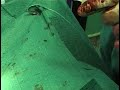 avance de la tuberosidad tibial  tta 