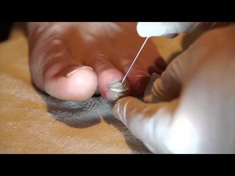 how to drain blood from under toenail