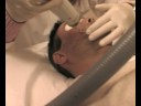 Fraxel laser- is painful Part 2 Fraxel laser- is painful Part 2
