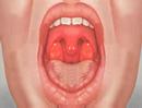 gerd and atrial fibrillation, information about acid reflux and choking cough in adults, gerd and problems breathing when asleep