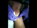 Botfly pops out of leg