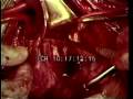 10328_open_heart_surgery