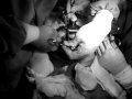 histrectomia por Dr Santillana R4GO IMSS zacapoaxtla puebla