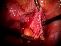 laparoscopic ovarian endometrioma cystectomy