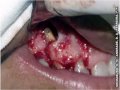 ENDODONTIA – CIRURGIA PARENDODÔNTICA