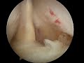 arthroscopic subscapularis reduction