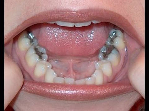Please Remove “Silver Fillings” ASAP!