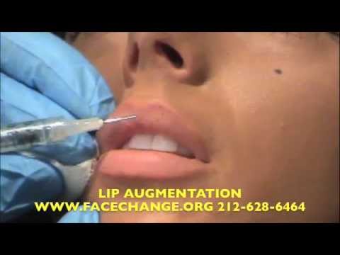 Detailed video describing lip augmentation, enhancement and enlargement 
