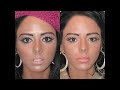 LIP AUGMENTATION AND ENLARGEMENT LIP AUGMENTATION AND ENLARGEMENT
