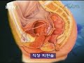 性転換 ニューハーフ専用 SexReassignment Surgery in Korea.