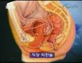 性転換 ニューハーフ専用 SexReassignment Surgery in Korea.