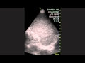 Ultrasound Image Of The Spleen In Mononucleosis Ultrasound Image Of The Spleen In Mononucleosis