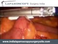 Laparoscopic Robotic assisted resection of duodenal and small bowel diverticula in India
