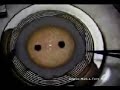 DLEK 5.0mm corneal Transplant Surgery