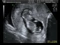 Quijanito 2 meses