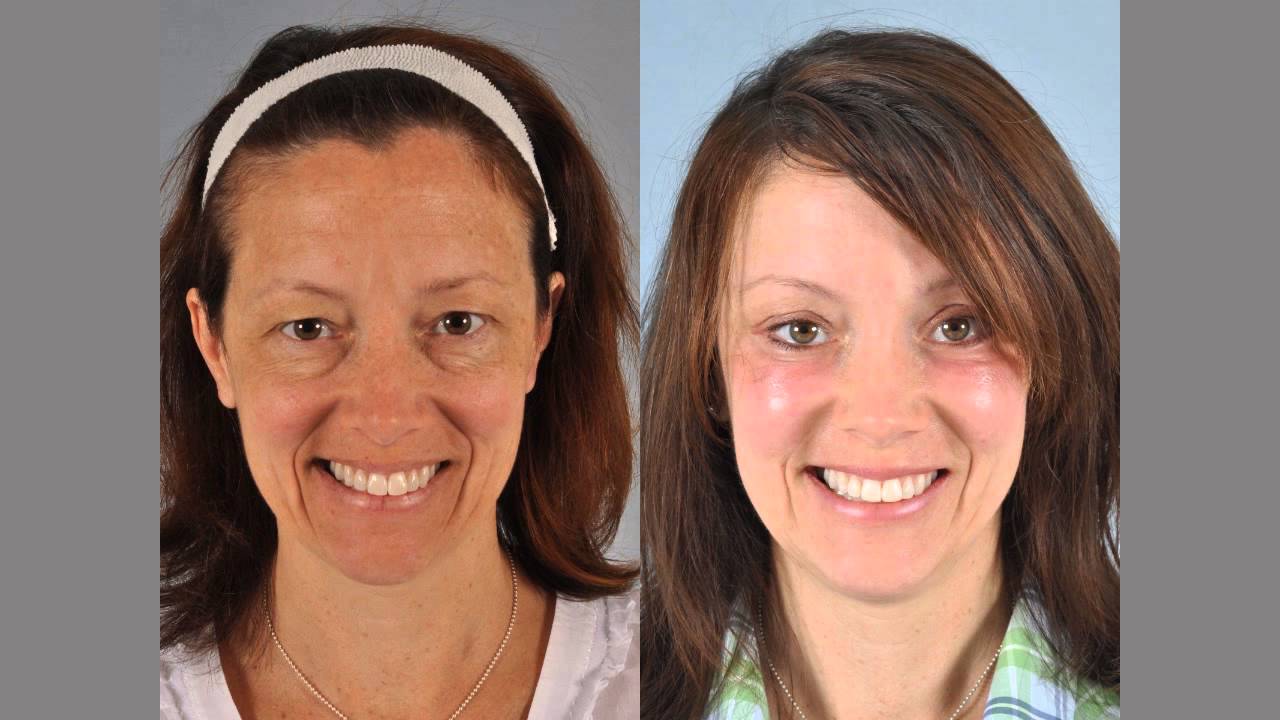 WNaturallift Testimonial at W Cosmetic Surgery: Karen