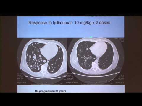 Approach to Treatment in Post-Surgical and Metastatic Melanoma Patients