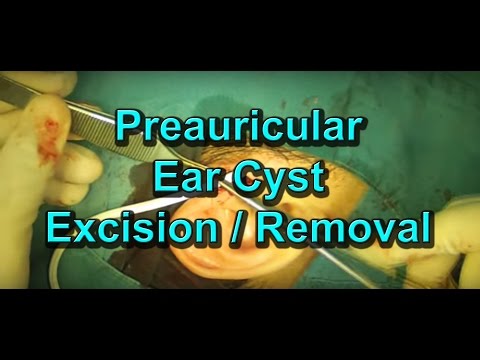 how to drain preauricular pit