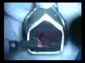 Idiopathic subglottic stenosis Idiopathic subglottic stenosis