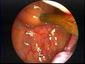 The Endoscopic Removal of a Hanging Polyp The Endoscopic Removal of a Hanging Polyp