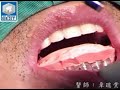 dental-implants.html