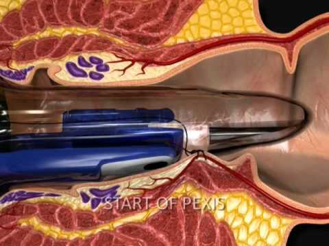 anal