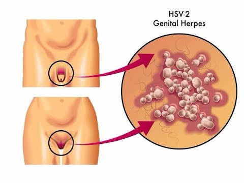 how to cure genital herpes naturally