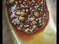 litiasis vesicular