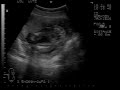 21 Week Ultrasound- Our baby boy