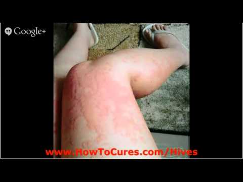 how to cure aquagenic pruritus
