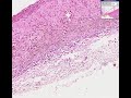 Histopathology Small intestine, duodenum--Peptic ulcer