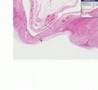 Histopathology Small intestine, duodenum--Peptic ulcer