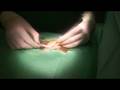 videos de Surgery part 2/2