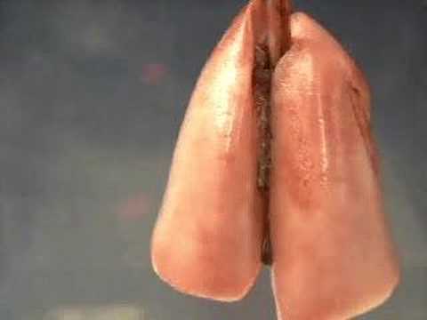 how to perform lung recruitment maneuver