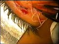 Parásito palpebral - Extracción Parásito palpebral - Extracción