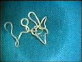 parásito palpebral   extracción