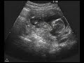 Ultrasound Fetal Response To Alcohol Fetal Alcohol Syndrome