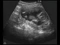Ultrasound Fetal Response To Alcohol Fetal Alcohol Syndrome